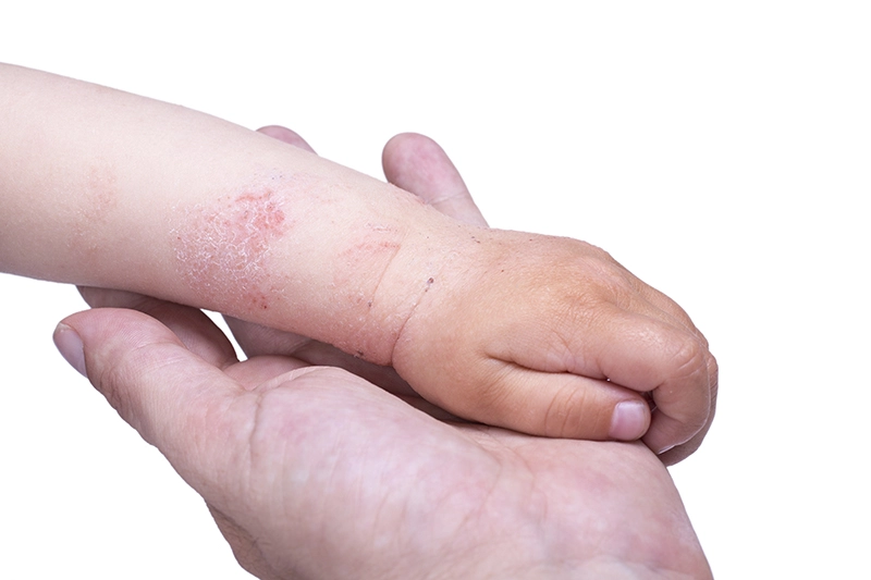 Miért csak az én gyerekem keze száraz? Az atópiás bőrtípusról…